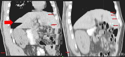 Advances in gross tumor target volume determination in radiotherapy for patients with hepatocellular carcinoma